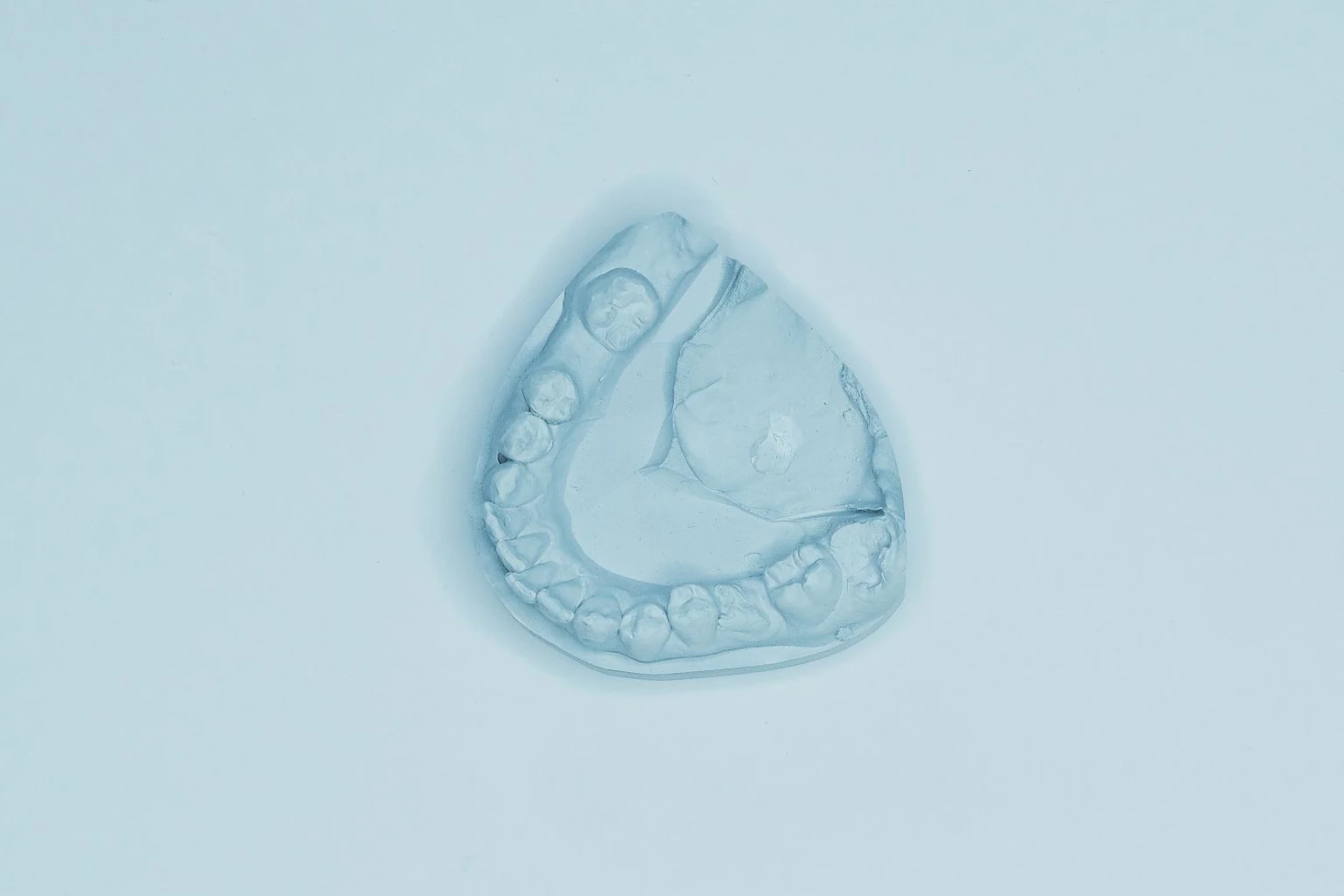 A dental radiograph showing periapical infection, prepared for a spreading-infection evidence review
