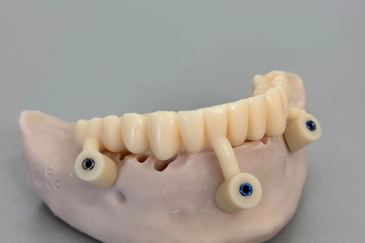 An implant-supported full-arch dental prosthesis on a jaw model, prepared for an implant-failure evidence review