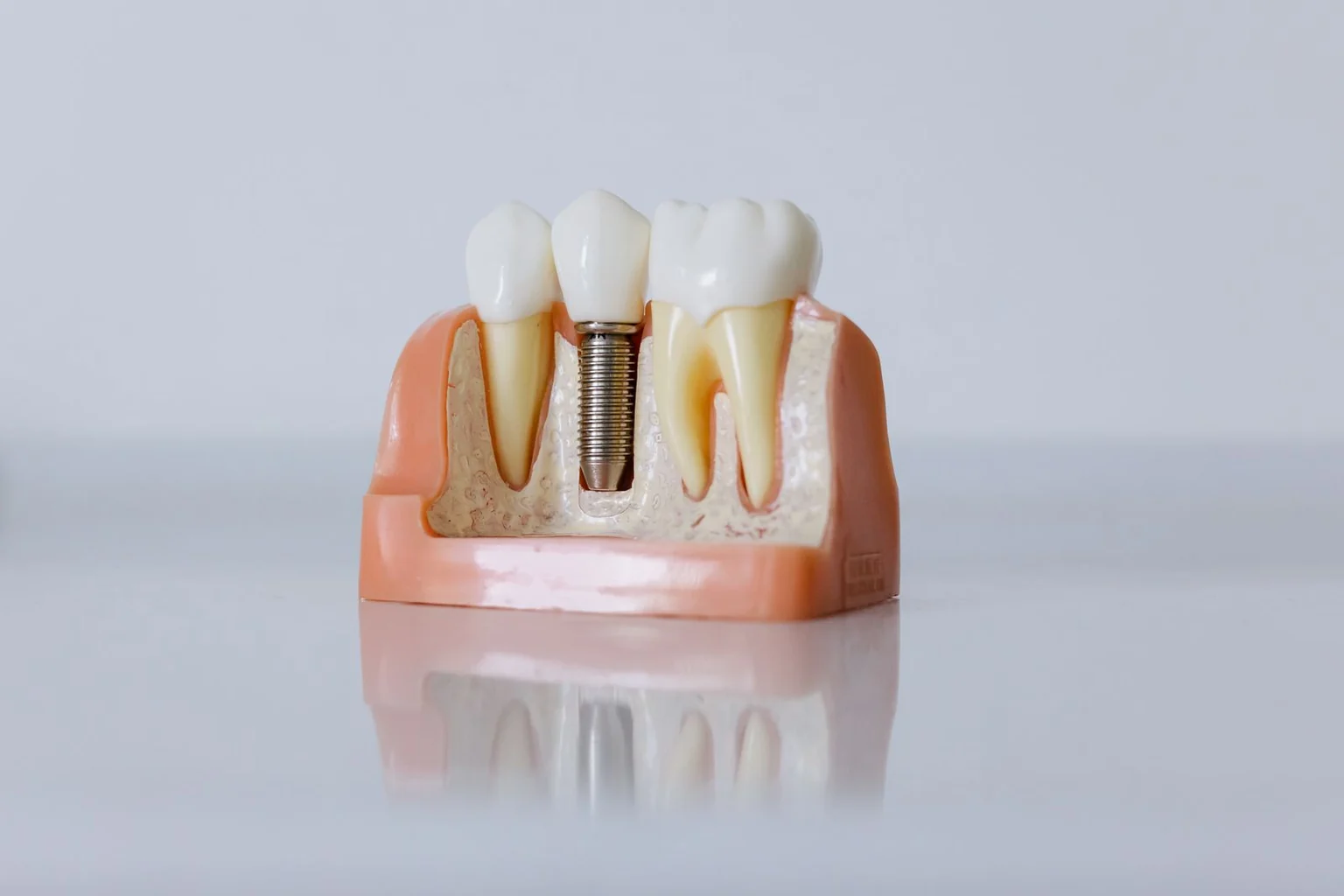 A cross-section dental model showing a dental implant placed in the bone beside natural teeth