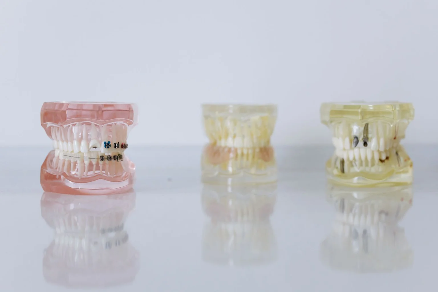 Dental demonstration models, one fitted with fixed orthodontic braces