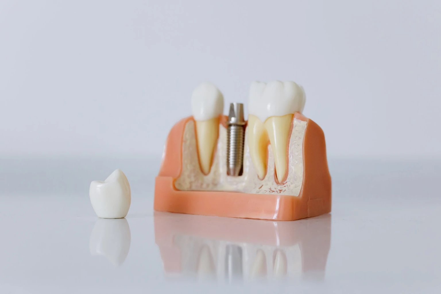 Dental implant demonstration model and a separate crown, illustrating the restorations costed across a lifetime of care
